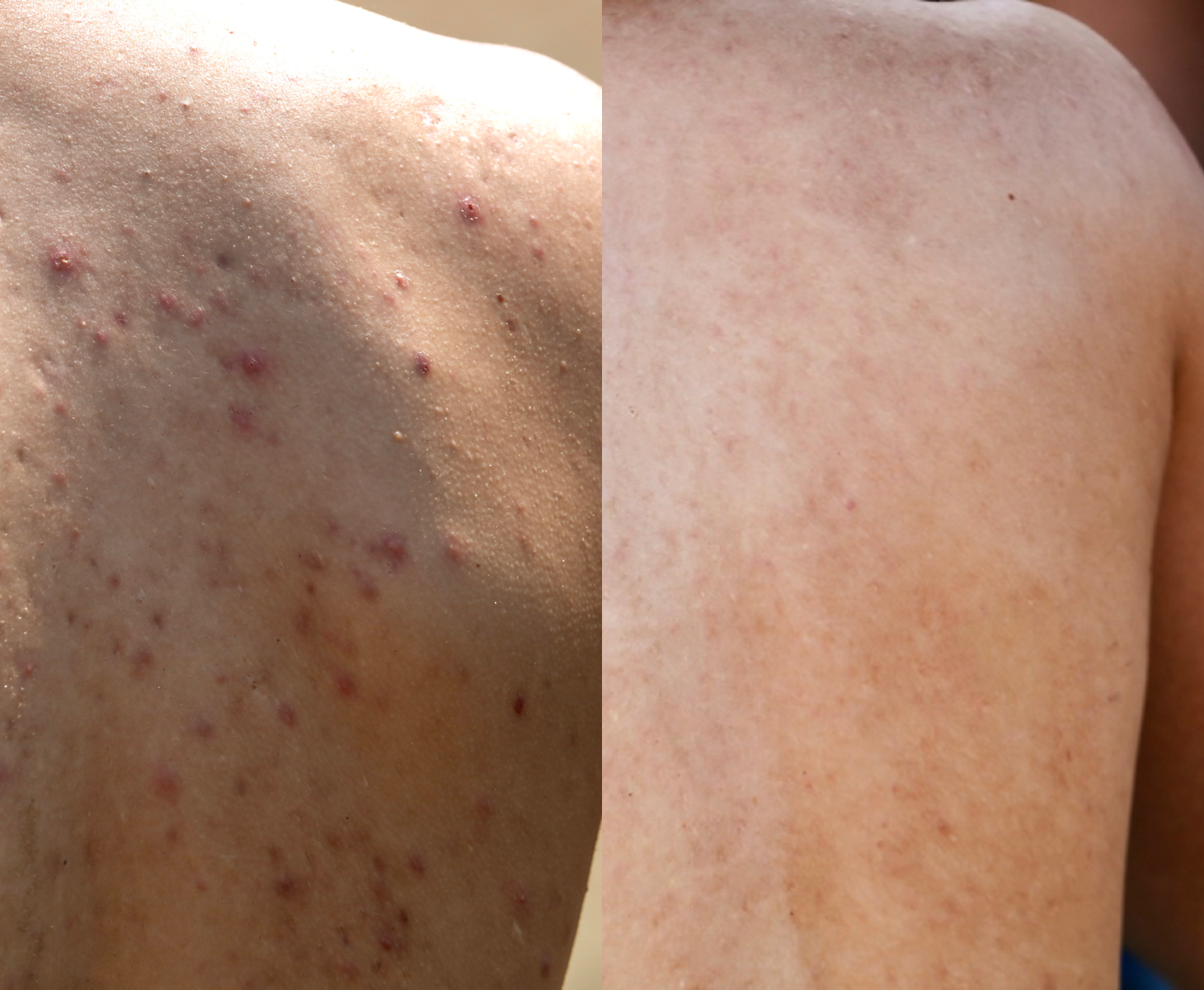 ACNE BODY DUO