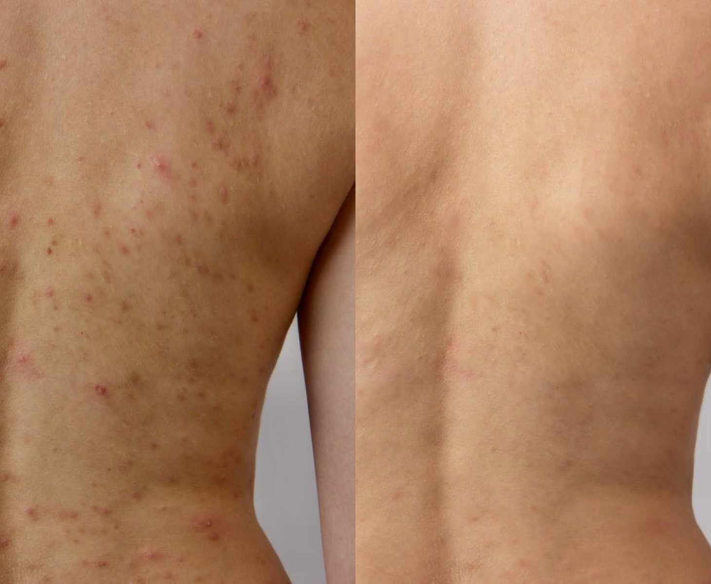 ACNE BODY DUO